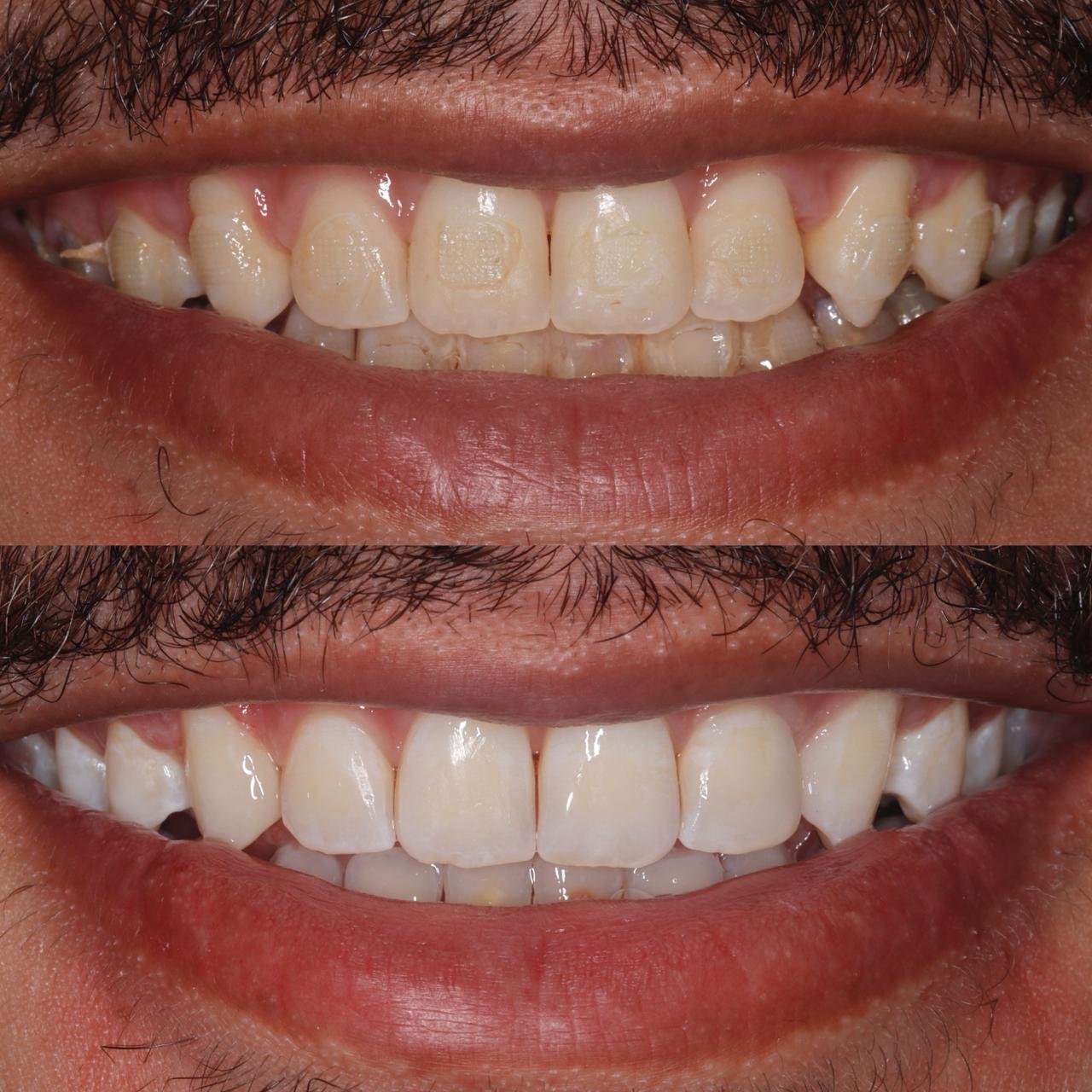 Blanqueamiento dental OdontoLeón