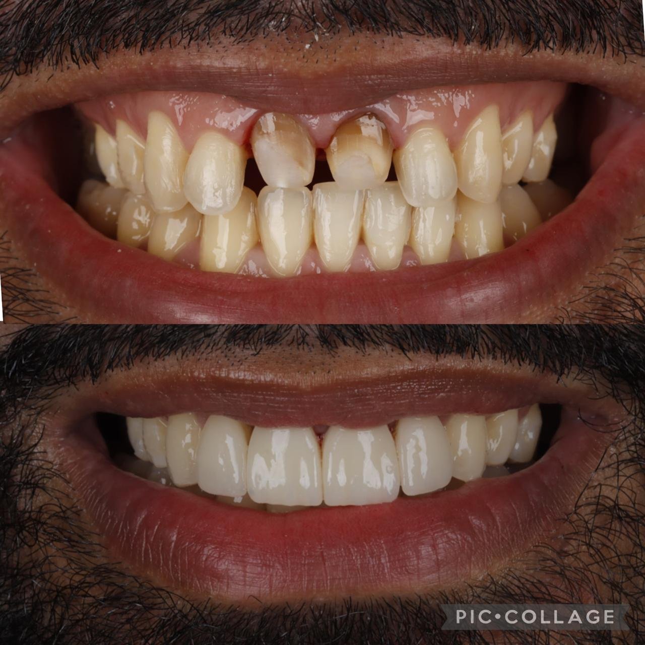 Coronas dentales antes y después – OdontoLeón