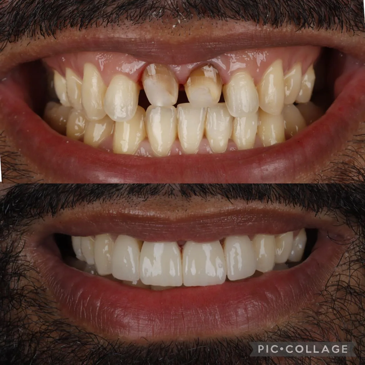 Coronas dentales antes y después – OdontoLeón