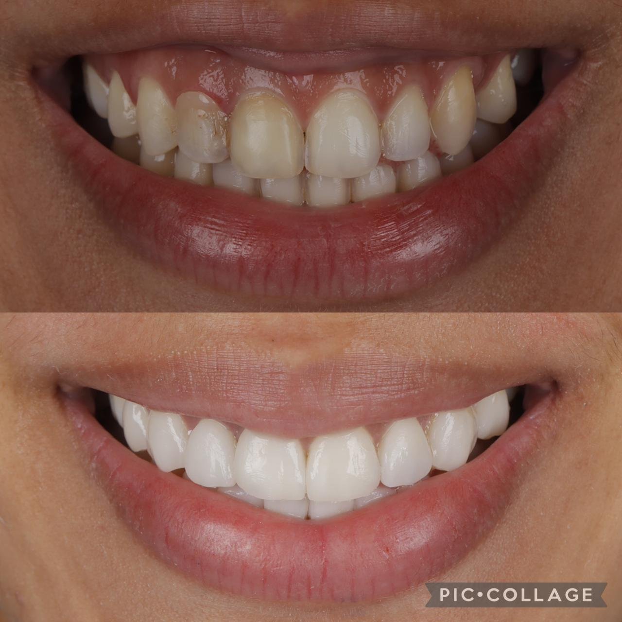 Carillas de porcelana OdontoLeón