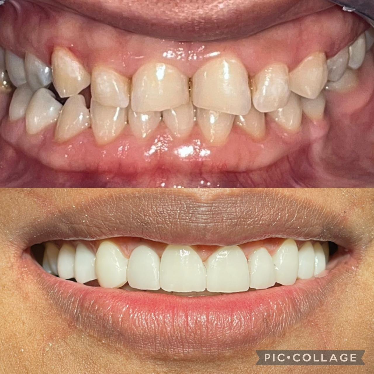 Diseño de sonrisa antes y después – OdontoLeón