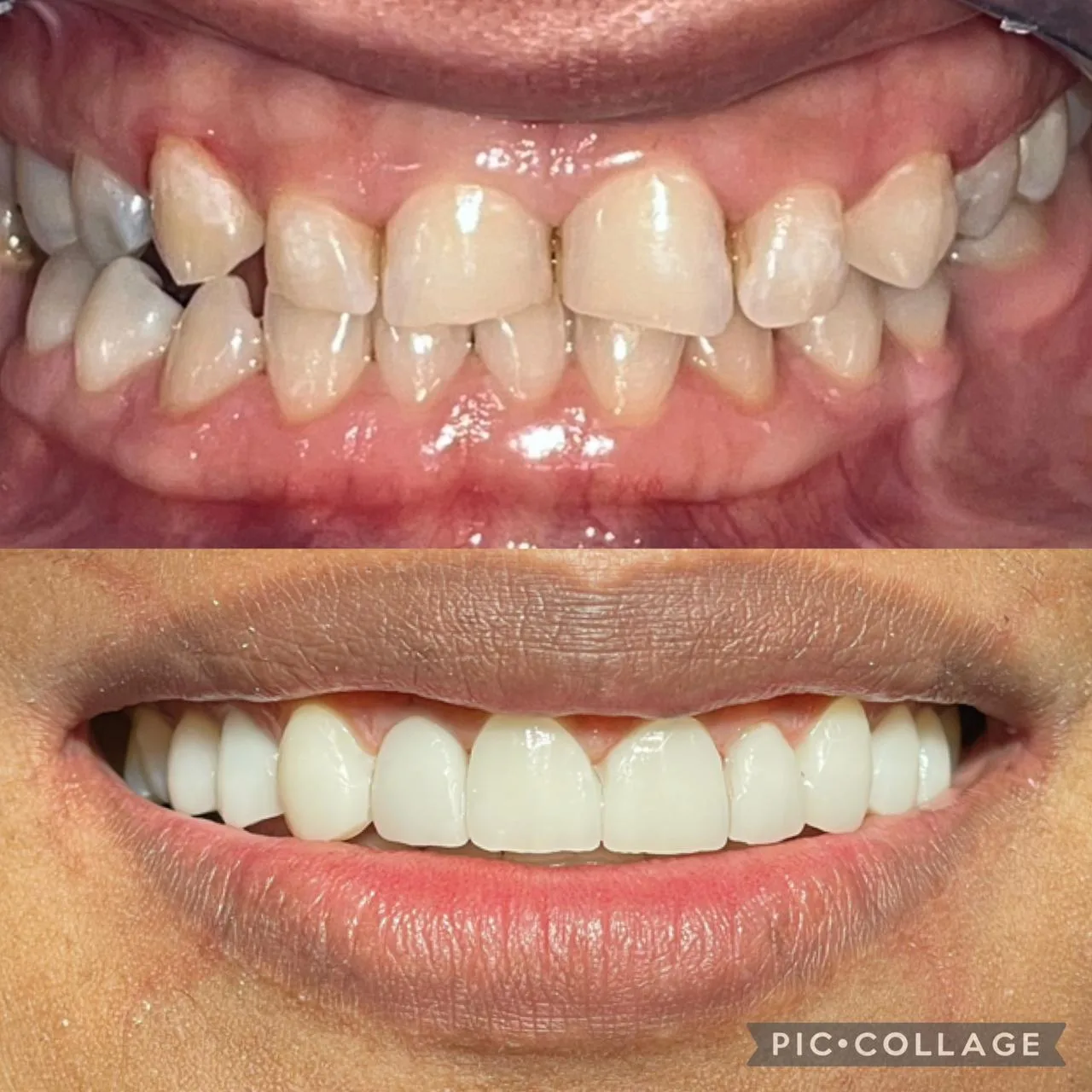 Diseño de sonrisa antes y después – OdontoLeón