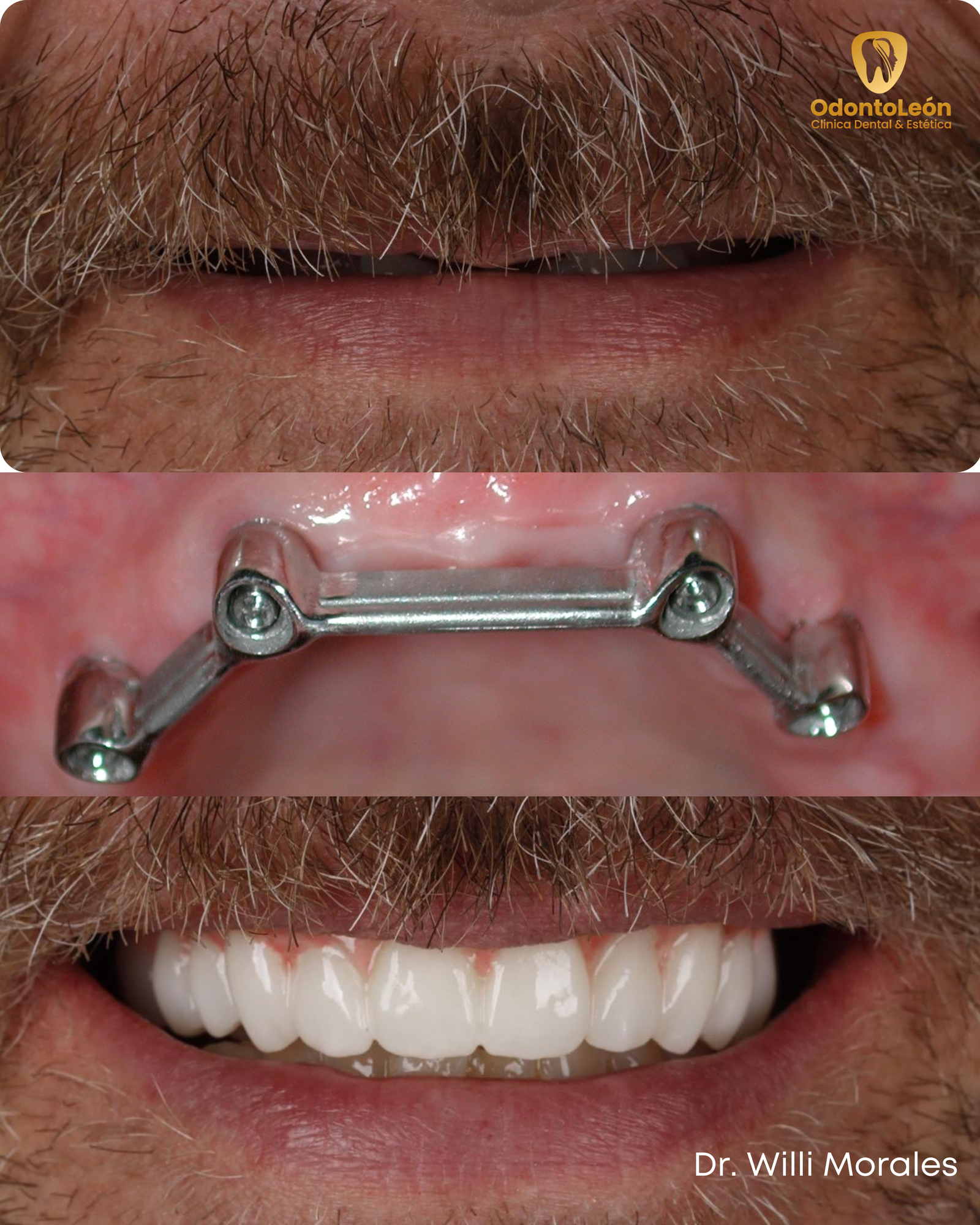 Implante dental e híbrida OdontoLeón