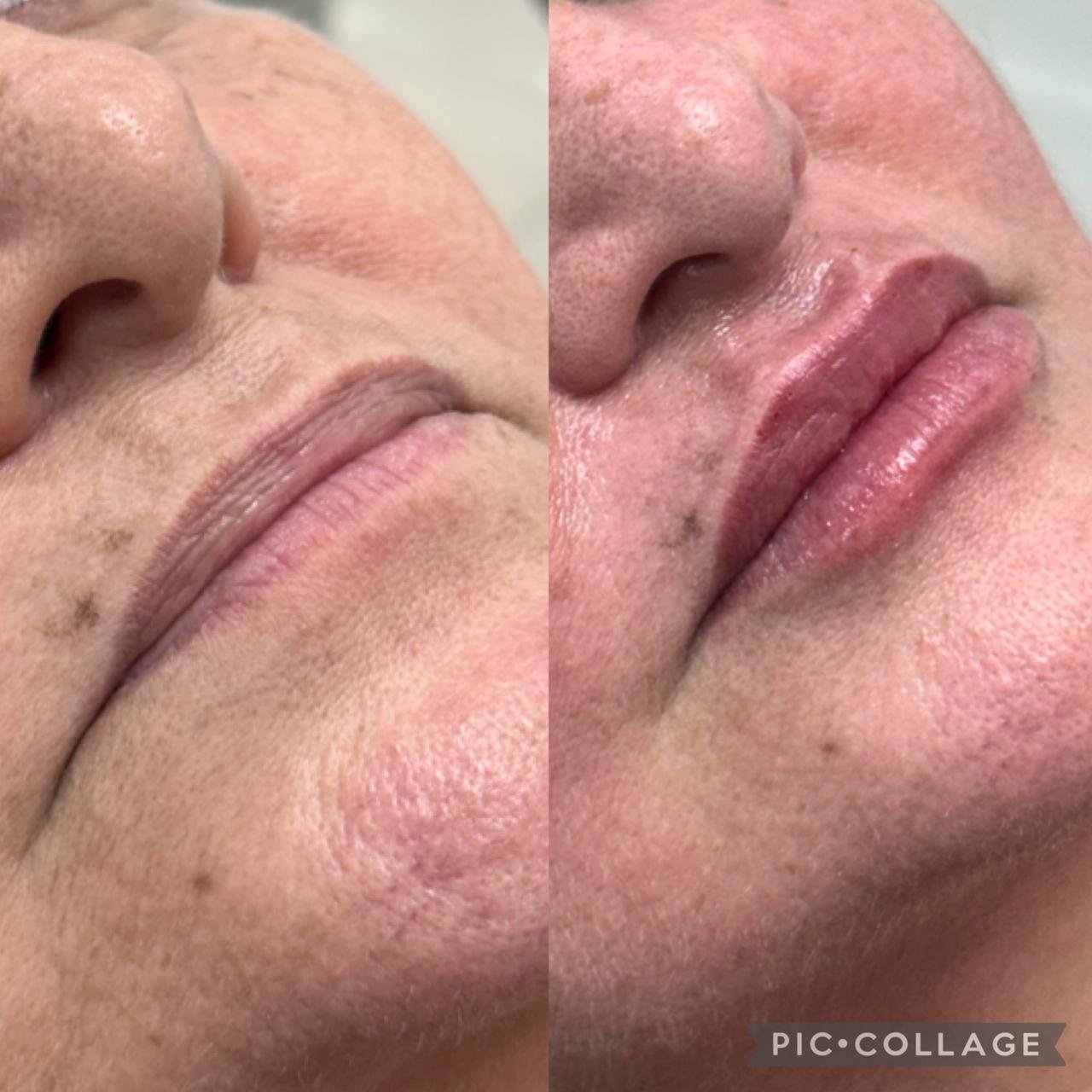 Relleno de labios antes y después – OdontoLeón