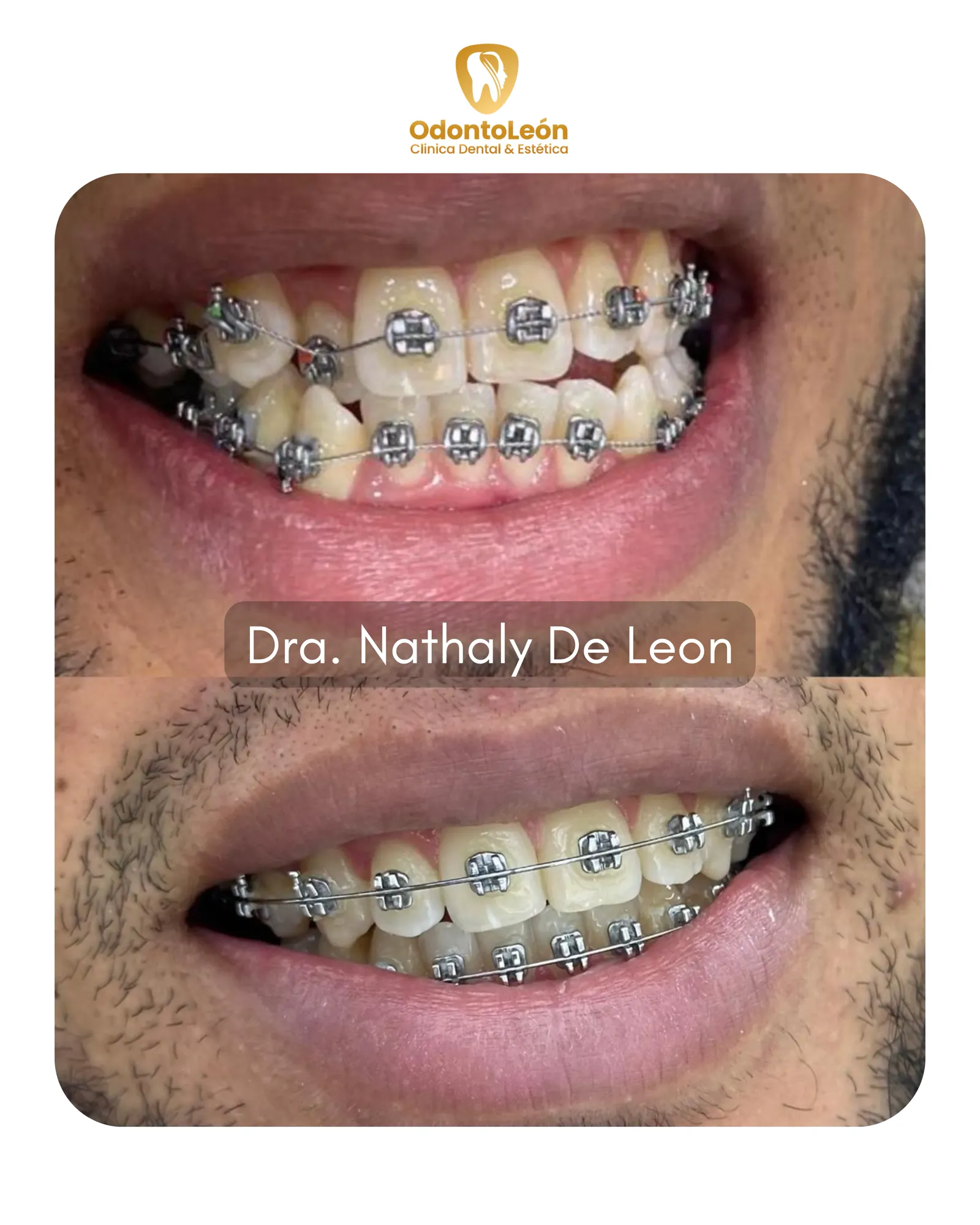 Ortodoncia OdontoLeón - Dra. Nathaly De Leon